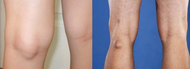 베이커낭종은 무릎 뒤쪽이 혹처럼 낭종이 부풀어 오르는 것이 대표적인 증상이다.
