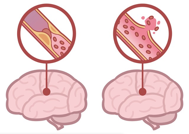 혈관이 막히는 것을 ‘뇌경색(왼쪽)’, 혈관이 터져 출혈이 발생하는 것을 ‘뇌출혈’이라고 한다. 뇌졸중은 뇌경색과 뇌출혈을 일컫는 말이다./사진=게티이미지뱅크