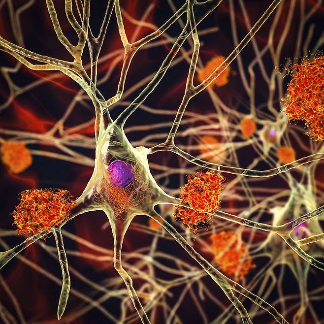 알츠하이머 환자의 뇌에서 신경세포 사이에 베타 아밀로이드 단백질들이 뭉쳐 덩어리를 이룬 모습(주황색)의 상상도. 베타 아밀로이드 덩어리가 알츠하이머병의 원인으로 지목됐지만 최근 의문을 제기하는 사람들이 많았다./SCIENCE SOURCE
