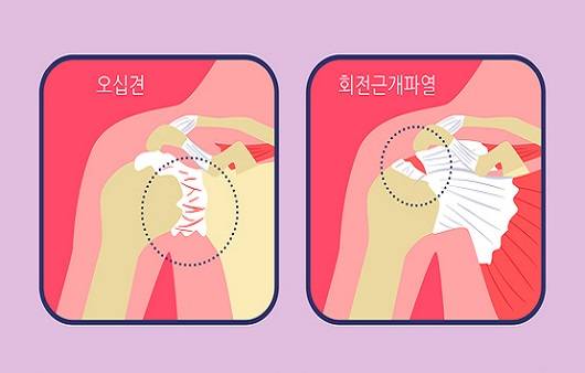 오십견과 회전근개 파열ㅣ출처: 게티이미지 뱅크