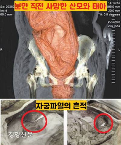 X-레이 촬영결과 미라의 뱃속에 태아의 골격이 보이고 있었다. 태아가 뱃속에 있었다. 산모는 출산직전에 자궁 파열로 인한 저혈량성 쇼크로 태아와 함께 사망한 것으로 판단됐다.|김한겸 고려대 의대 명예교수 제공