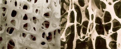 정상인의 뼈(왼쪽)와 골다공증 환자의 뼈. 한국일보 자료사진