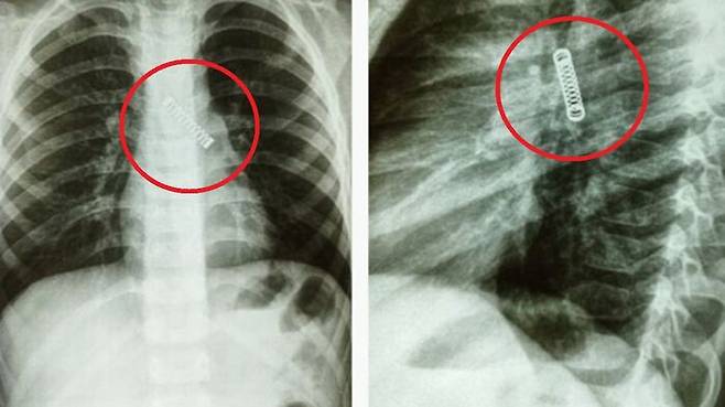 5살 난 파라과이 남자아이 폐에 박혀 있던 3cm 길이 금속 스프링. (사진=카를로스 모리니고 인스타그램 캡처)
