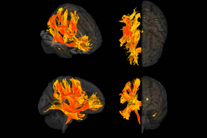 고혈압이 뇌의 각 부위에 미치는 영향의 정도를 나타낸 3D 그래픽. 빨간색은 영향을 가장 많이 받는 부위를 나타내며 노란색은 상대적으로 영향을 덜 받는 부위에 해당한다. 뇌에서 정보전달 통로 역할을 하는 백질에서 주로 많은 손상이 발생한 모습이다. Lorenzo Carnevale 제공