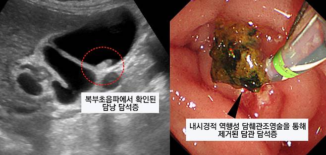 복부초음파(왼쪽), 내시경적 역행성 담췌관조영술(ERCP)를 통해 확인된 담석증(오른쪽)/순천향대학교 부천병원 제공