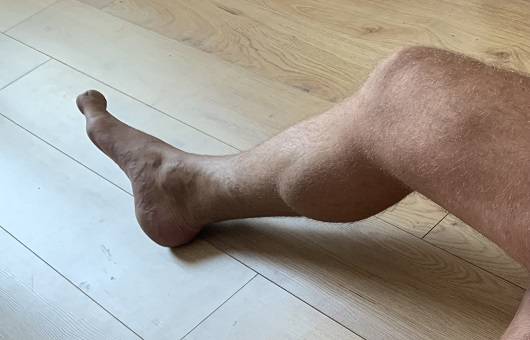 근육이 과발달한 종아리ㅣ출처: 게티이미지뱅크