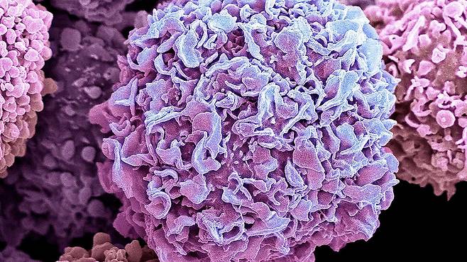 유방암 세포의 전자현미경 사진. 암세포는 다른 세포보다 빨리 자라 산소 소모도 많다. 배터리를 암 조직에 붙이면 산소 소모를 더 촉진해 항암제 효과를 극대화했다./Science Photo  Library