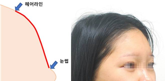 헤어라인과 눈썹이 높아 '매끈-봉긋'한 이마