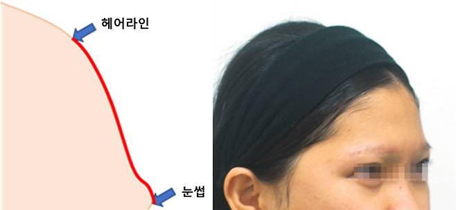 헤어라인과 눈썹이 낮아 '돌출-함몰-평평'한 이마
