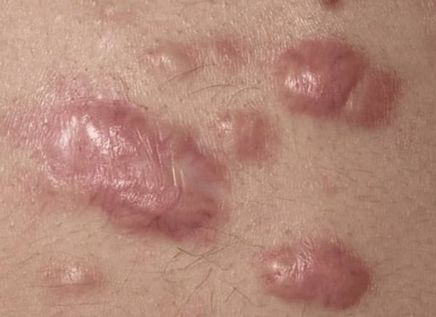 켈로이드 흉터는 주변의 정상적인 피부를 침범해 번져가는 게 특징이다. 사진제공=Thomas Habif