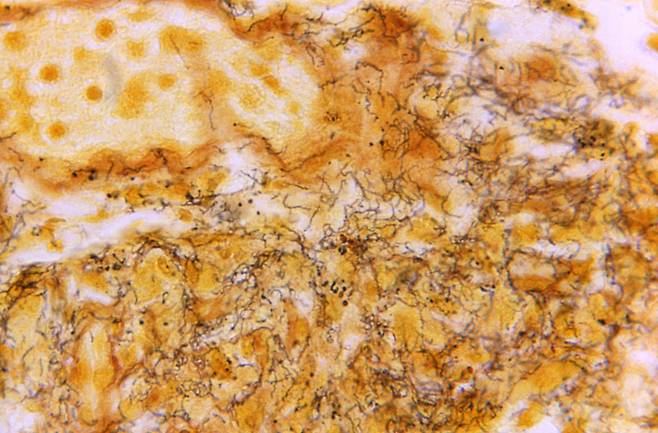 미 질병통제예방센터(CDC)가 제공한 현미경으로 관찰한 트레포네마 팔리듐균. /AP 연합뉴스