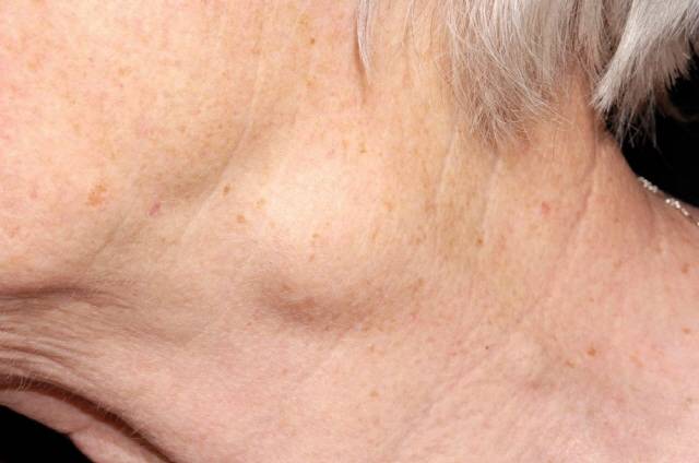 몸에 생긴 멍울이 지나치게 빠른 속도로 커지면 악성 종양(암)을 의심해보는 게 좋다./사진=클립아트코리아