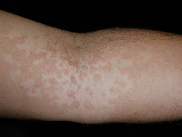 여름철 흘리는 땀을 닦지 않고 방치하면 어루러기가 생길 수 있다./사진=클립아트코리아