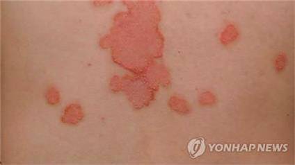 건선 [연합뉴스 TV 캡처: 작성 김선영(미디어랩)