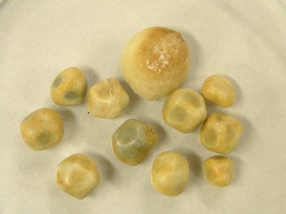 콜레스테롤 담석 이미지. 사진 병원 제공