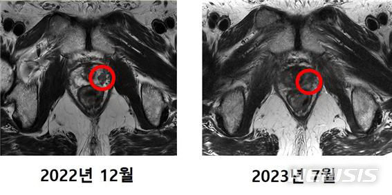 [서울=뉴시스]국내 첫 중입자치료 환자 MRI 비교 사진. (사진= 세브란스병원 제공) 2023.09.19. photo@newsis.com.