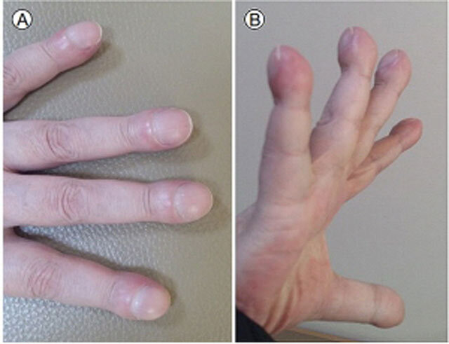 폐암 환자 일부는 손가락 끝이 뭉뚝해지는 증상이 나타난다./사진=대한내과학회지
