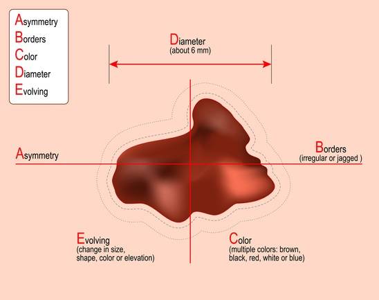 ‘ABCDE 룰(rule)’을 통해 피부암과 점을 구분할 수 있다. ABCDE는 점의 비대칭성(Asymmetry), 불규칙한 경계(Border irregularity), 다양한 색깔(Color variegation), 6mm 이상 크기(Diameter), 크기·모양 변화(Evolving)를 의미한다. / 사진= 게티이미지뱅크