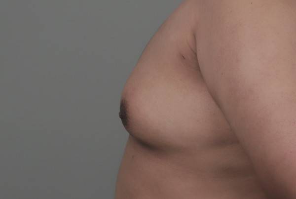 여성형 유방증 진단을 받은 10대의 가슴. 사춘기를 지나면 대개 증상이 사라지지만 일부는 성인까지 이어지기도 한다. 아이디병원 제공