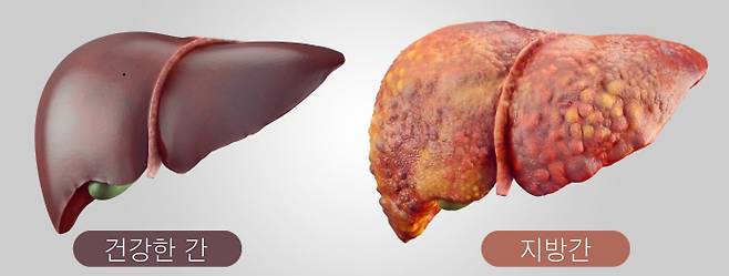 건강한 간과 지방간. 지방간은 지방이 많이 만들어지거나 잘 배출되지 않아 생기는 병이다./Terdon Gastroenterology Associates
