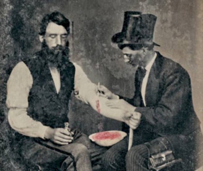 1860년대, 피를 뽑고 있는 환자 모습. 피를 담는 그릇으로 탄생한 것이 퀘이치라는 설이 있습니다. /위키피디아