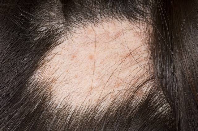 두피에 형성된 탈모반 모습. 클립아트코리아