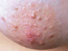 몽고메리 결절 사진/사진=Advances In Dermatology And Venereology