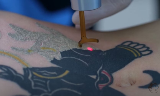 박영수 컴포트성형외과 원장이 레이저로 문신을 지우는 시술을 하고 있다. [유튜브 ‘문신 지우는 영수쌤’ 캡처]