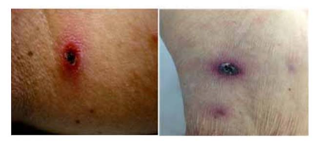 중쯔쯔가무시증/사진=질병관리청