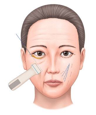 초음파와 실리프팅을 이용한 하안검 수술 및 중안면 거상의 모식도.