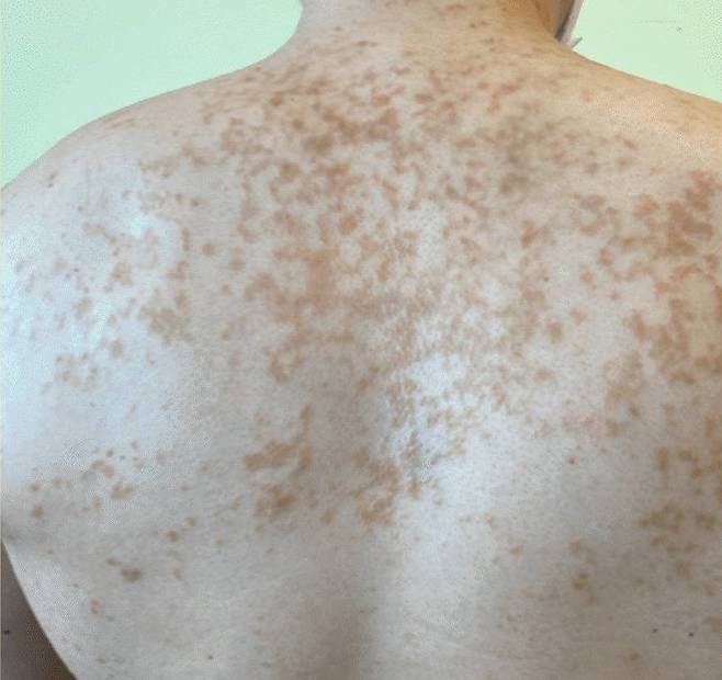 등에 나타난 색소성 양진./사진=과학 저널 'Cureus'