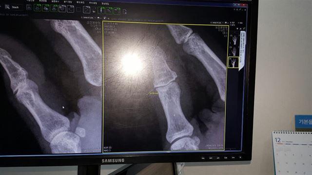 학교급식실에서 13년 근무한 조리실무사의 휘어진 손가락 엑스레이(X-ray) 사진. 전국학교비정규직노동조합 경기지부 제공