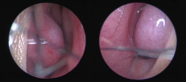 알레르기비염 환자의 비강 내시경 사진. 코점막과 하비갑개가 부어있고 맑은 콧물이 보인다. 사진 제공=고대안산병원