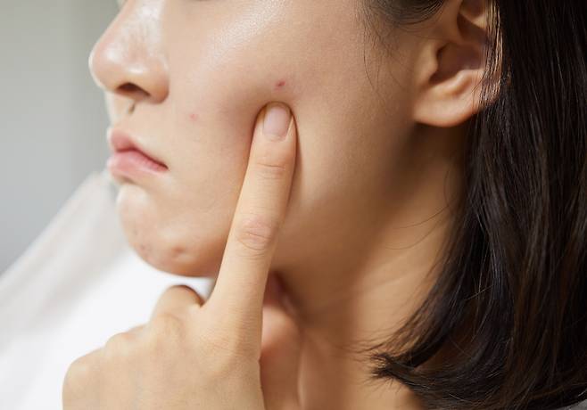 여드름을 악화시키는 건 손에 있는 세균보다 '물리적 자극'이다./사진=게티이미지뱅크