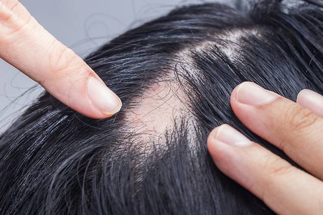 모발이 점차 가늘어지다가 어느 순간부터 머리 위쪽에 탈모가 진행된다면 다낭성난소증후군 때문일 수 있다./사진=게티이미지뱅크