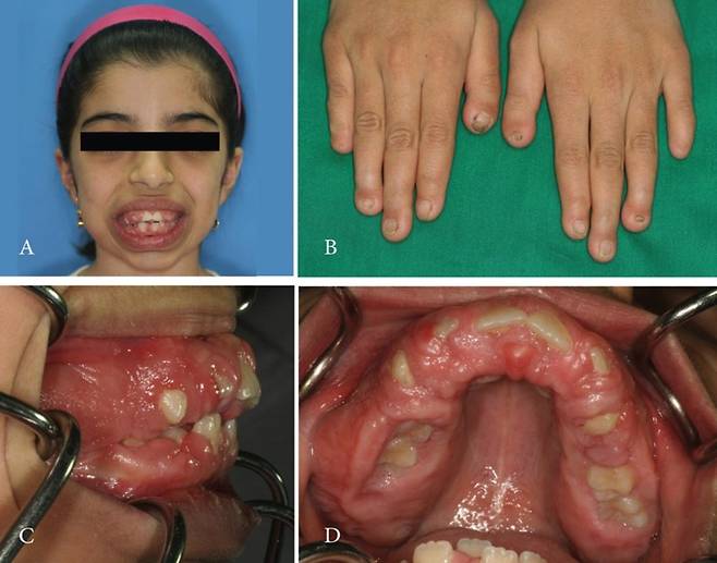 지머맨-레이밴드 증후군은 얼굴과 손발의 기형을 일으키는 희귀 유전 질환이다​./사진=Journal of Clinical and Experimental Dentistry