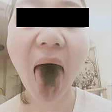 알프라졸람 복용 뒤 혀에 검은 털이 자라는 '흑모설'을 겪은 30대 여성./사진=임상사례보고
