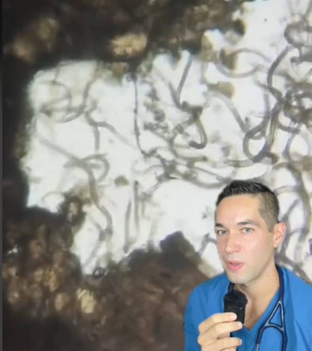 마이로 박사가 손톱 밑 때를 현미경으로 확대하자 수많은 박테리아가 발견됐다./사진=틱톡 채널 'doctormyro' 캡처