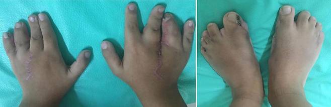 다지증, 합지증이 있었던 멕시코 6세 남아가 치료 수술을 받은 후 모습./사진=국제외과저널사례보고