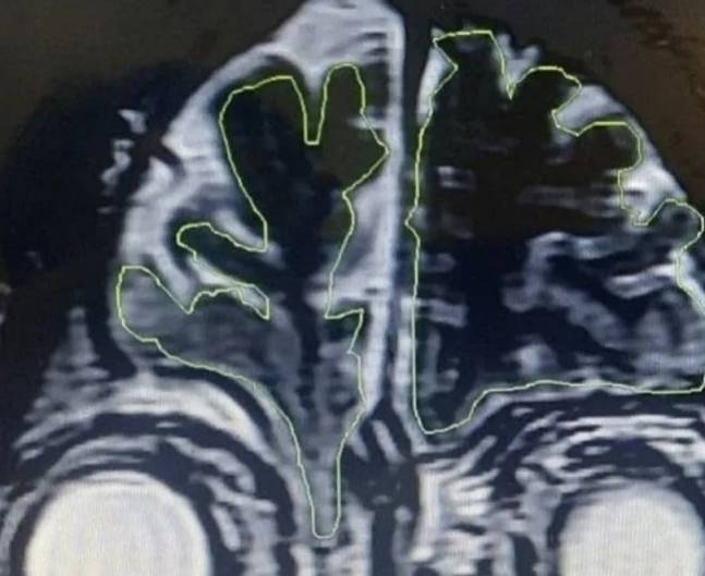 교통사고로 인한 머리 부상 후 6년간 뇌척수액(초록색 부분)이 깨진 두개골을 통해 코로 흘러내린 A씨의 MRI 사진. 페이스북