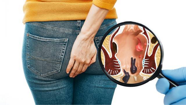 치질은 추위에 약한 질환이다ㅣ출처: 클립아트코리아