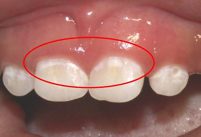 치아 표면의 흰색 반점은 '치아우식증'의 초기 증상일 수 있다./사진=NORMAN TINANOFF, DDS, MS.