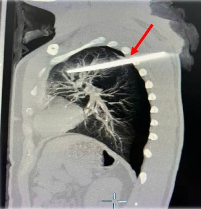 괴한에 의해 칼에 찔려 가슴에 칼(빨간색 화살표로 표시된 부분)이 박힌 베트남 20대 남성의 엑스레이 사진/사진=자딘 닷 베트남