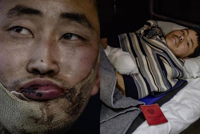 우크라이나군이 러시아 쿠르스크주에서 생포한 북한군 저격수(왼쪽 사진·26)와 소총수(20)의 모습. 현재 우크라이나 수도 키이우 모처에서 치료받고 있다. 볼로디미르 젤렌스키 우크라이나 대통령 엑스 캡처