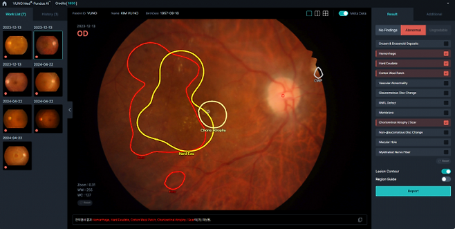 눈의 이상소견을 살피는 소프트웨어 의료기기인 '펀더스'. 뷰노 제공.