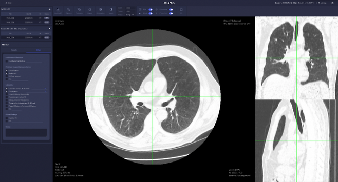 폐 CT 영상을 분석하는 소프트웨어 의료기기인 'LungCT'. 뷰노 제공.