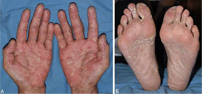 매독 환자의 손(A)과 발(B) 실제 병변. /사진=메이요클리닉
