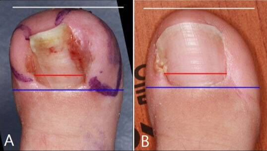 연부조직 절제 후 발톱 폭의 비율을 이미지 분석 방식을 통해 분석한 결과, 수술 전(A) 발톱 폭이 좁았던 상태에서 수술 후(B) 발톱 폭의 비율이 최대 52.52%까지 개선됐다.
