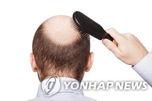 탈모. 서울아산병원