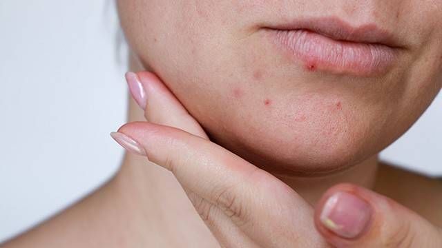 모낭염은 약해진 피부 속으로 세균 등이 침투해 발생한다 ㅣ출처: 게티이미지뱅크